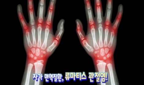 면역체계의 이상 류마티스 관절염