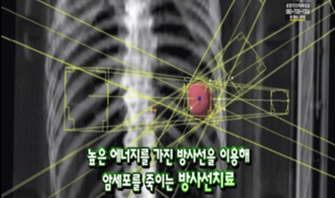 방사선 치료 제대로 이해하기