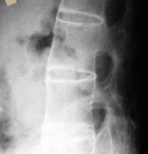 강직성 척추염 사진3