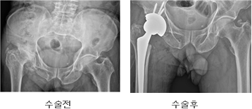 인공관절 사진2