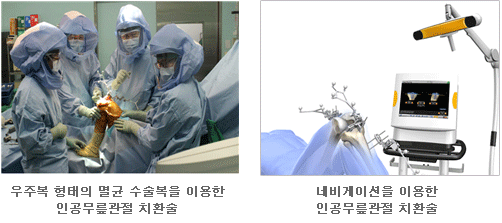 인공관절 사진3