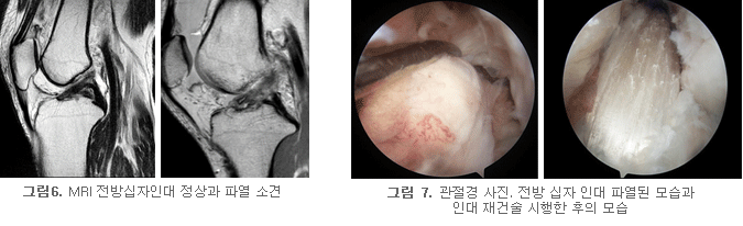 전후방 십자인대파열 사진1