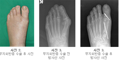 무지 외반증 사진1
