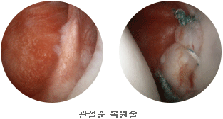 견관절질환 사진1